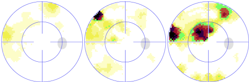 Champ visuel qui s’aggrave progressivement sur 10 années (le scotome en noir augmente au fil des examens). Il faut augmenter le traitement ou opérer le glaucome.