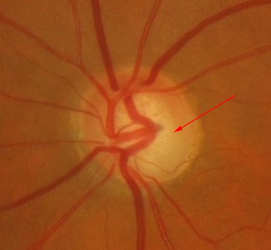 Le nerf optique est glaucomateux le glaucome détruit les fibres visuelles et creuse le nerf optique