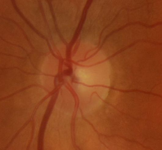 Le nerf optique est normal et bien charnu : les fibres visuelles sont intactes