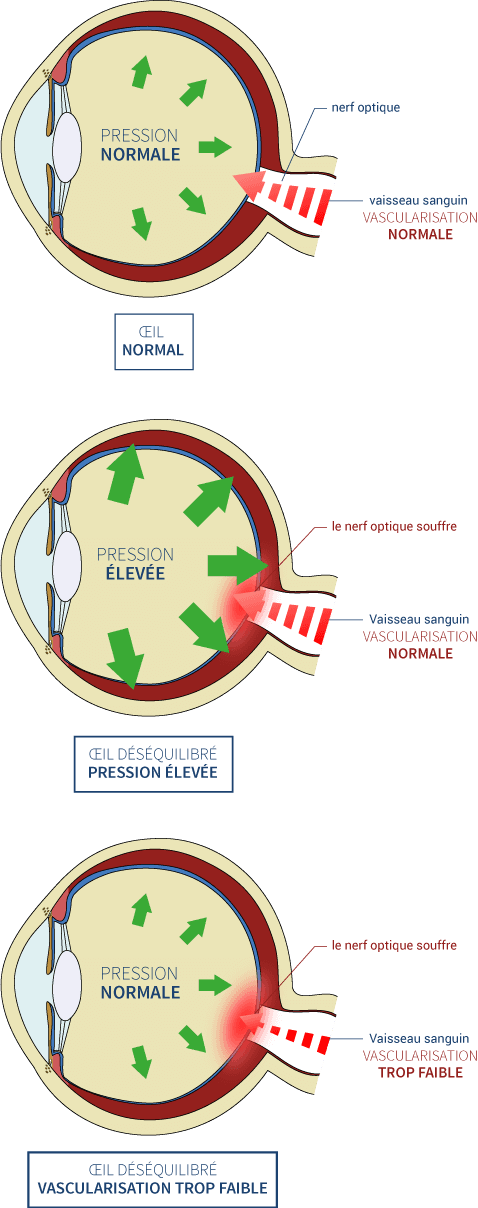 Les glaucomes vasculaires à pression normale ou modérée