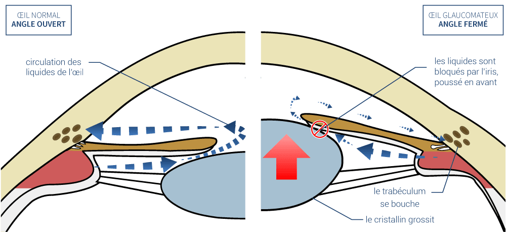 Glaucomes à angle fermé - Institut du glaucome Nantes