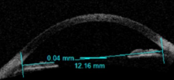 après laser, les liquides ne sont plus bloqués derrière l’iris et ne poussent plus l’iris en avant, L’œil est décomprimé