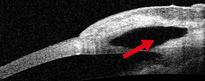 Apres chirurgie du glaucome, les liquides sortent de l’œil se concentrent dans la bulle de filtration sous la conjonctive avant d'être résorbés par les tissus