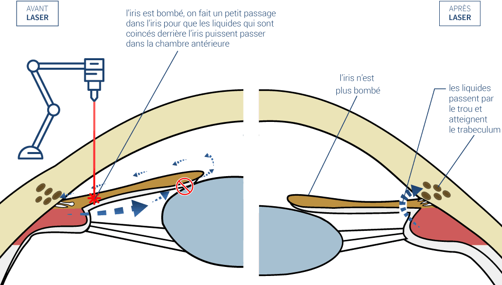 iridotomie périphérique au laser