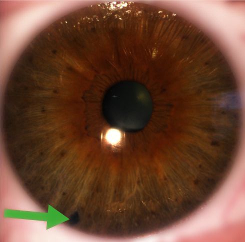 iris après traitement au laser : on voit l'iridotomie, trou par lequel passent désormais les liquides