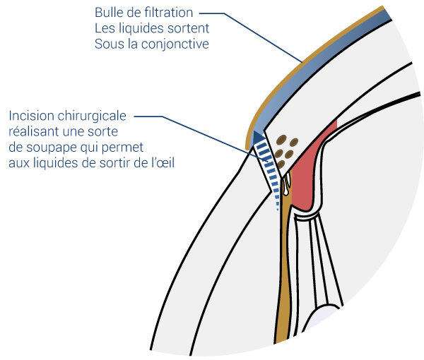 trabéculectomie